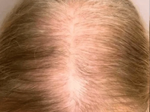 pattern hair loss