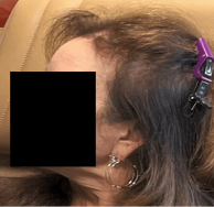 Female pattern hair loss