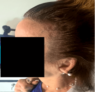 Female pattern hair loss