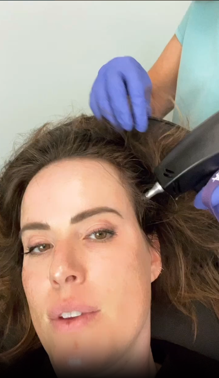 Alma-TED™-Hair-Restoration-in-Bellevue-WA-Hair-Oh-Yeah