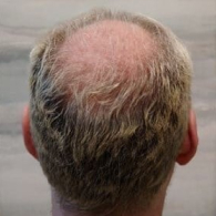 fuller-head-of-hair-after-img