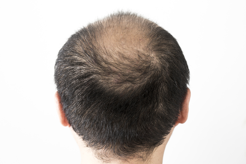 Hair Loss In Men: 17 Most Common Causes