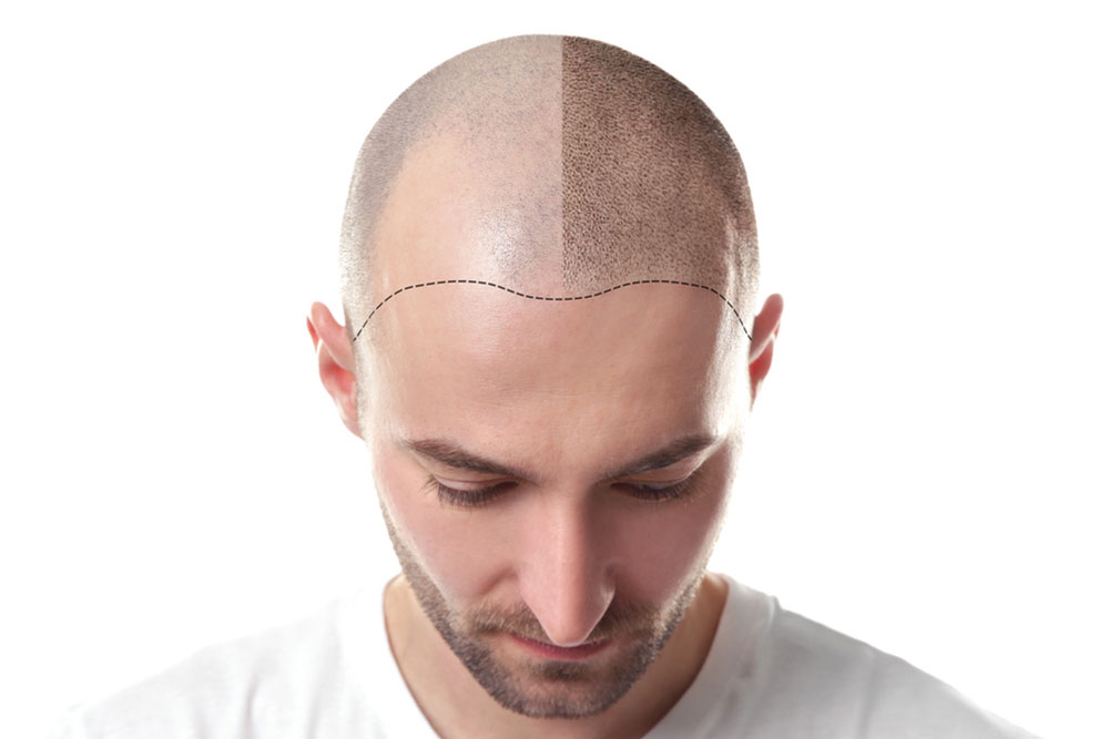 Laser Treatment For Hair Growth Explained